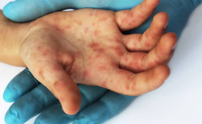 México acumula 3 mil 292 casos de viruela del mono